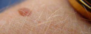 Skin Moles