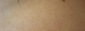 Which type of skin cancer is the most dangerous?