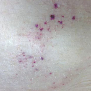 bright pink spots on skin