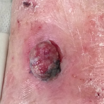 Example pictures of melanoma