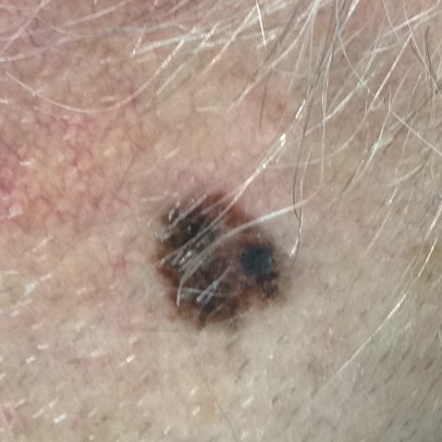 Example pictures of melanoma