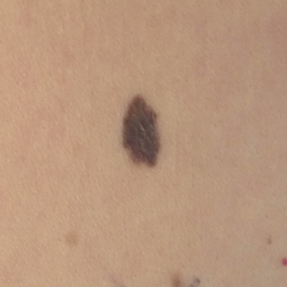 cancerous black moles