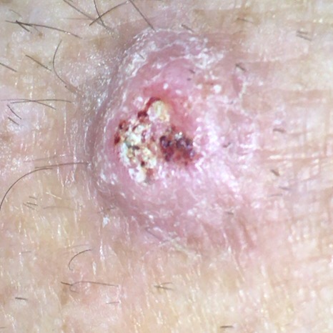 late squamous cell carcinoma