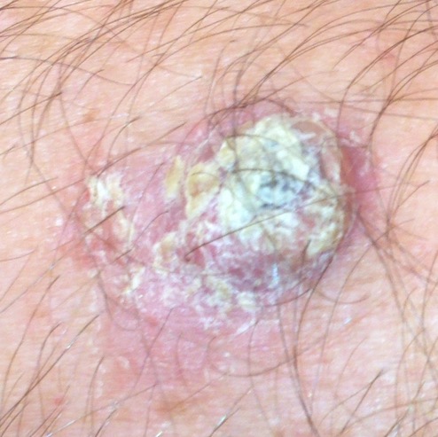 late squamous cell carcinoma