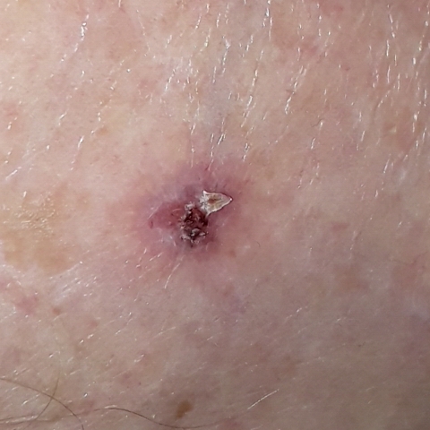 Example picture of basal cell carcinoma