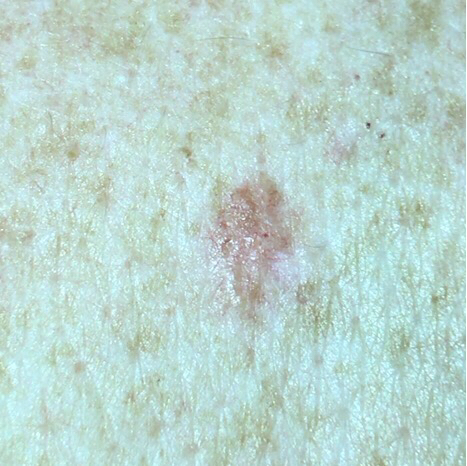 Example picture of basal cell carcinoma