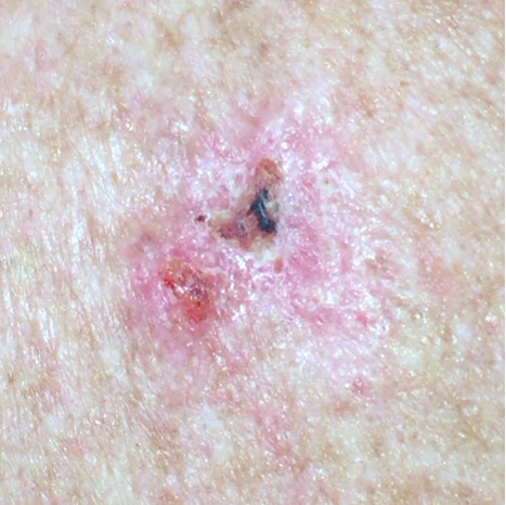 Crusty basal cell carcinoma