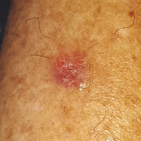 Itchy and red skin spot
